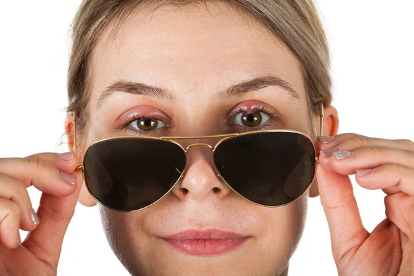 Imagen Cerca Una Mujer Enferma Sosteniendo Gafas Sol Chalazión Los — Foto de Stock