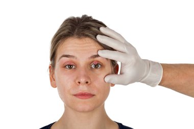 Kadın hasta göz enfeksiyonu. Hordeolum aseptik beyaz eldiven giyen doktor tarafından gösterilen üst göz kapağı üzerinde. Stafilokok