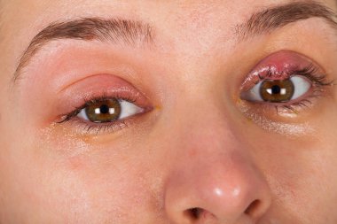 Close up picture of upper eyelid inflammation - chalazion - young female suffering from viral infection clipart