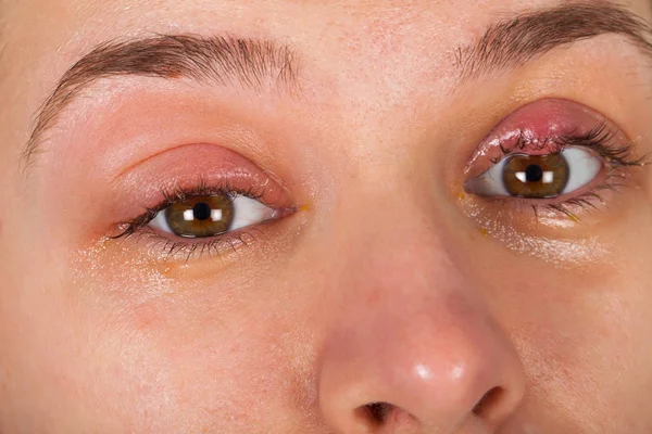 바이러스 으로부터 Chalazion 여자의 사진을 닫습니다 — 스톡 사진