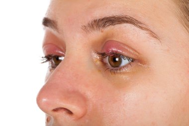 Genç erkek chalazion - üst göz kapağı iltihabı acı. viral enfeksiyon. Kameraya izole arıyorsunuz