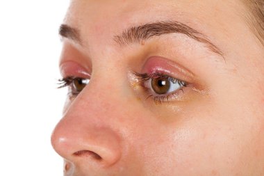 Young female suffering from chalazion - upper eyelid inflammation. viral infection. Looking to the camera on isolated clipart
