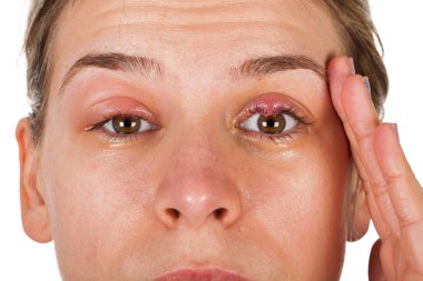 Genç erkek chalazion - üst göz kapağı iltihabı acı. viral enfeksiyon. Kameraya izole arıyorsunuz