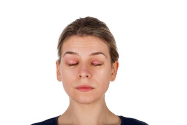 Genç erkek chalazion - üst göz kapağı iltihabı acı. viral enfeksiyon. Kameraya izole arıyorsunuz