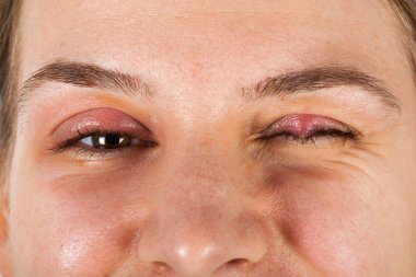 Genç erkek chalazion - üst göz kapağı iltihabı acı. viral enfeksiyon. Kameraya izole arıyorsunuz