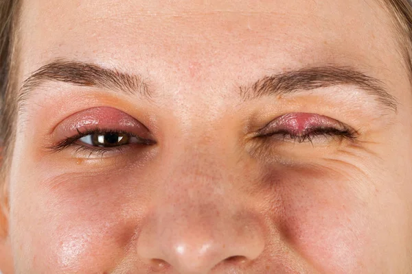 年轻女性患有粉刺 上眼睑炎症 病毒感染 看着孤立的相机 — 图库照片