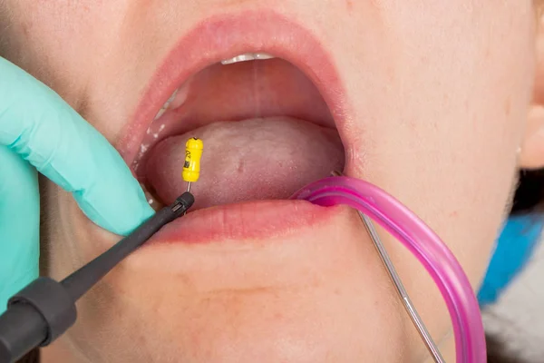 Immagine Ravvicinata Della Procedura Dentale Paziente Femminile — Foto Stock