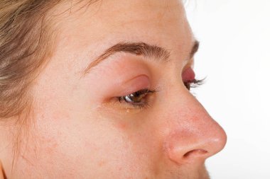  Hordeolum üst göz kapağı üzerinde. Viral enfeksiyon