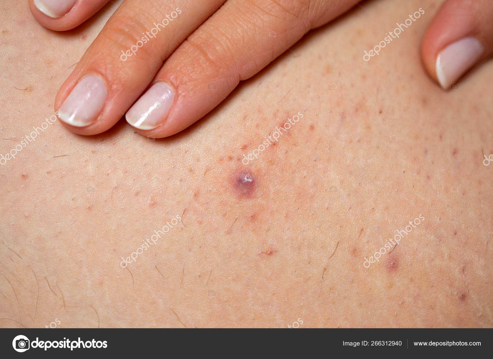 Que es foliculitis en la piel