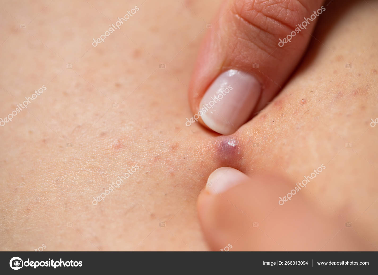 Que es foliculitis en la piel