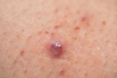 Painful folliculitis on female skin clipart