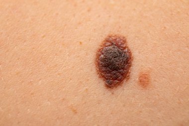 Ciltte tehlikeli nevus - melanom