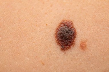 Dangerous nevus on skin - melanoma clipart