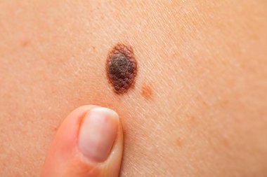 Ciltte tehlikeli nevus - melanom