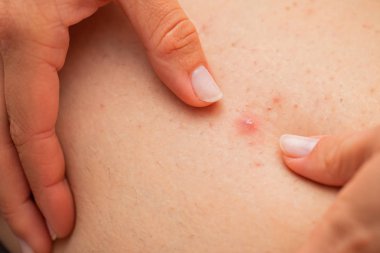 Kadın bacağında folikülit - sıkma