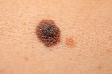 Ciltte tehlikeli nevus - melanom