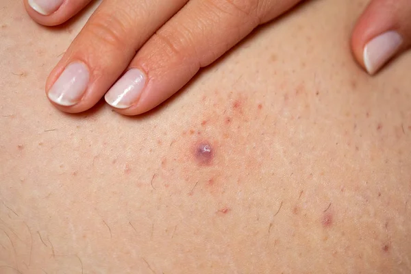 Foliculitis en la pierna femenina - apretando — Foto de Stock