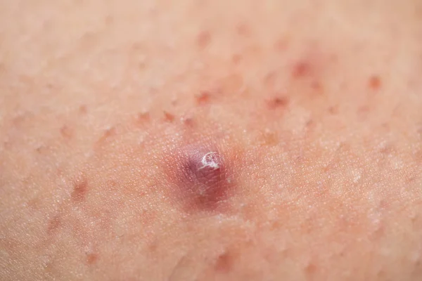 Bolesne zapalenie mieszków włosowych na skórze kobiet — Zdjęcie stockowe