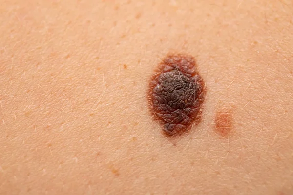 Nevo perigoso em pele - melanoma — Fotografia de Stock