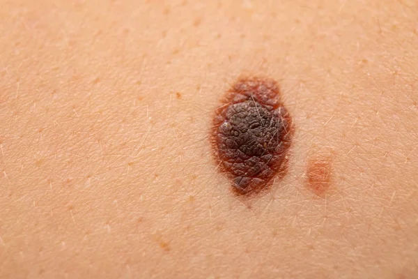 Nevo pericoloso sulla pelle - melanoma — Foto Stock