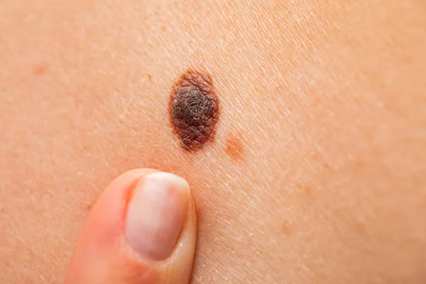 Nevus peligroso en la piel - melanoma — Foto de Stock