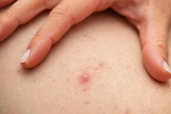 Folliculitis on female leg - squeezing — Stock Photo, Image