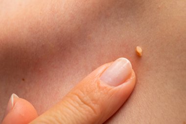 Papilloma on human skin clipart