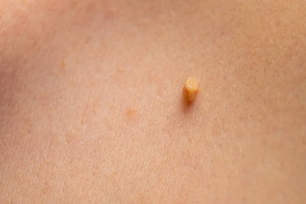 Papilloma pada kulit manusia — Stok Foto