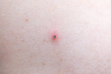 Kene ısırma kadın kolu (Ixodes ricinus)