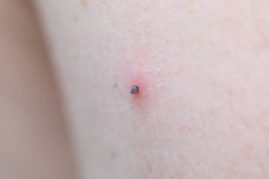 Kene ısırma kadın kolu (Ixodes ricinus)