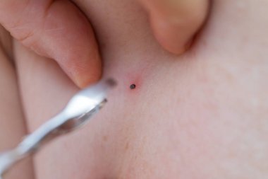 Kenenin insan derisinden çıkarılması