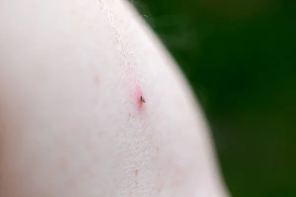 Tick biting woman\'s arm (Ixodes ricinus)