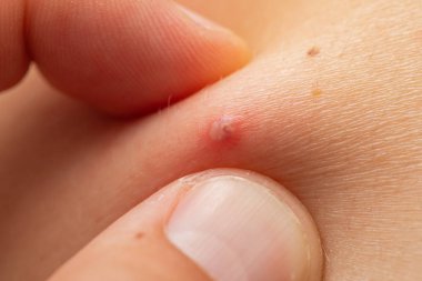 Irin dolu kırmızı sivilce