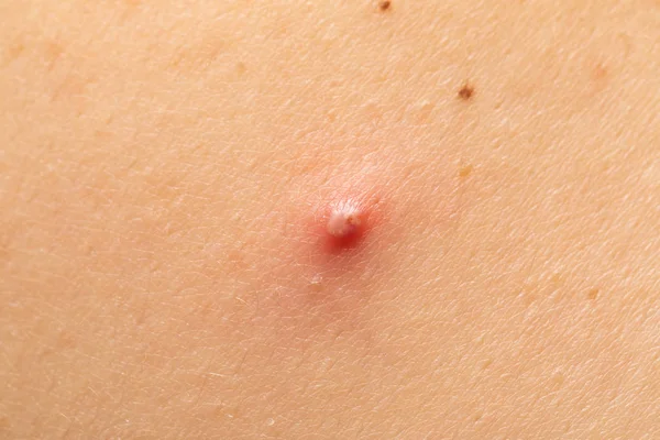 Espinha vermelha na pele humana — Fotografia de Stock