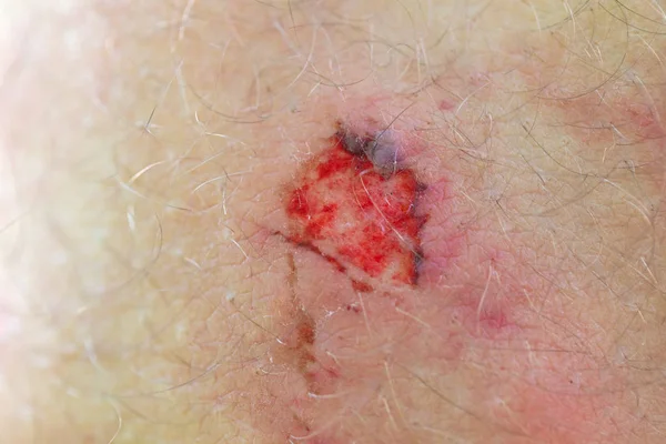 Bleeding lesion on human knee