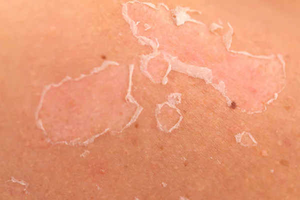 Пилинг кожи после солнечных ожогов — стоковое фото