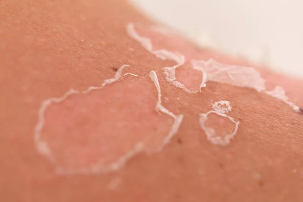 Skin peeling after sunburn