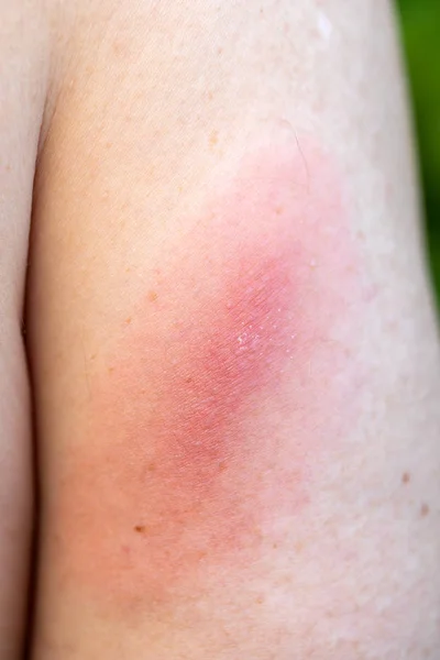 Lyme disease — Stock Photo, Image