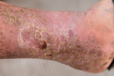 Yaya olarak enfekte olmuş bir yaranın resmini çek.