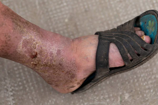Närbild Ett Infekterat Sår Till Fots — Stockfoto
