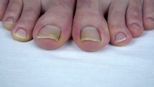 Large uncut toenails with fungus. The man has yellow toenails. Long did not cut your nails — Stock Video