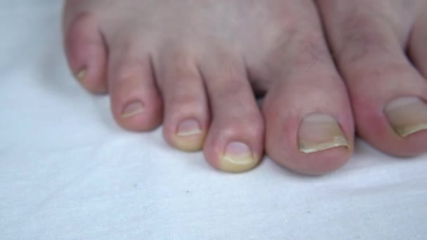 Grote ongesneden teennagels met schimmel. De man heeft gele teennagels. Long heeft je nagels niet gesneden. — Stockvideo