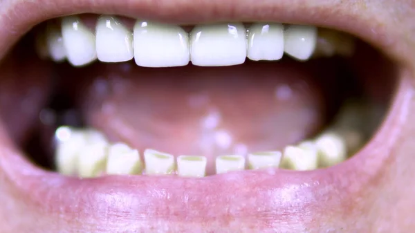 Old man shows teeth. The upper teeth are straight and the lower crooked. Man opened her mouth. close-up — Stock Photo, Image