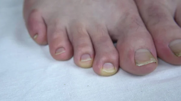 Large uncut toenails with fungus. The man has yellow toenails. Long did not cut your nails — Stock Photo, Image