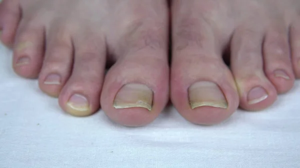 Large uncut toenails with fungus. The man has yellow toenails. Long did not cut your nails — Stock Photo, Image