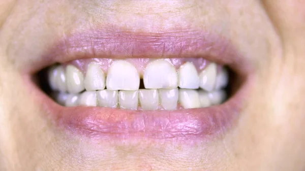 Old woman shows teeth. The upper teeth are straight and the lower crooked. close-up — Stock Photo, Image