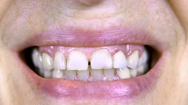 Η γριά δείχνει δόντια. Τα πάνω δόντια είναι ίσια και τα κάτω στραβά. κοντινό πλάνο — Φωτογραφία Αρχείου