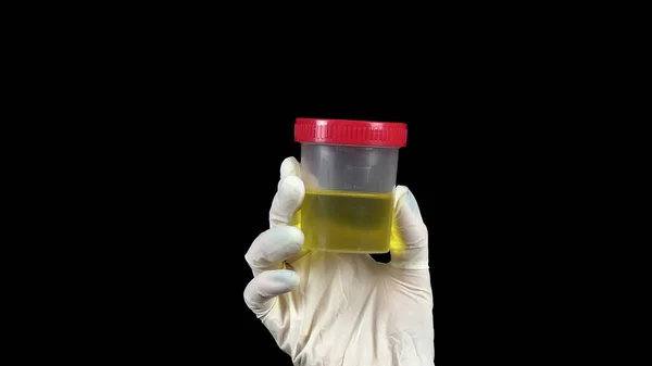 Orine in a Test Jar Close-up. El Doctor sostiene un tarro en un guante sobre un fondo negro . —  Fotos de Stock