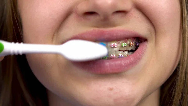 Girl with braces brush her teeth with a toothbrush closeup. A girl with colored braces on her teeth keeps her teeth clean. — Stock Photo, Image