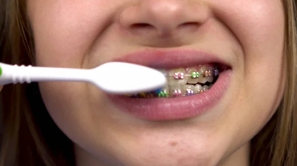 Girl with braces brush her teeth with a toothbrush closeup. A girl with colored braces on her teeth keeps her teeth clean. — Stock Photo, Image